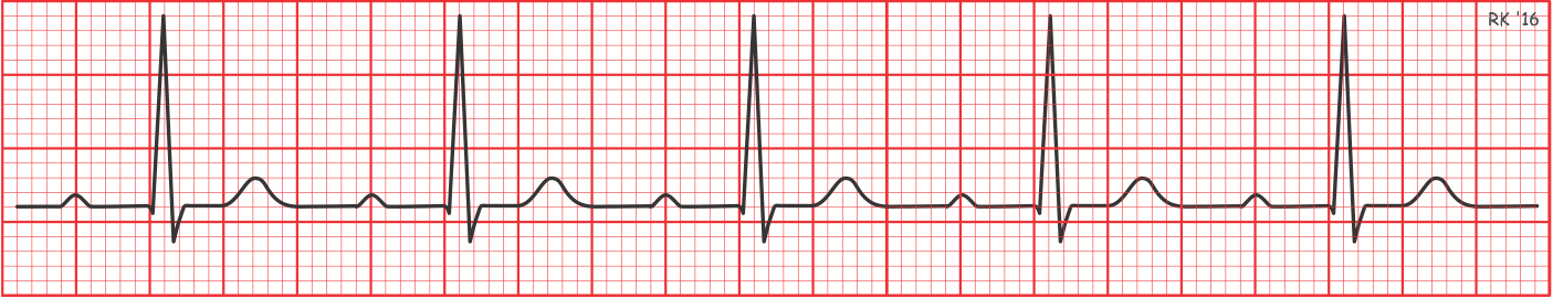 First degree AV block